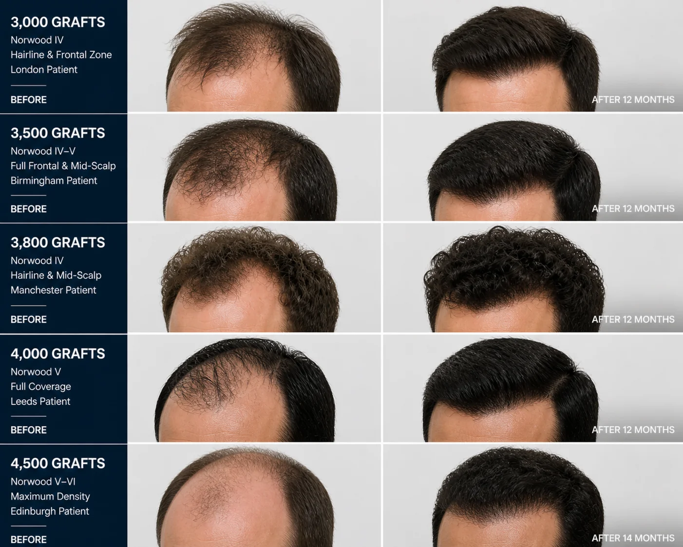 FUE Hair Transplant Before and After