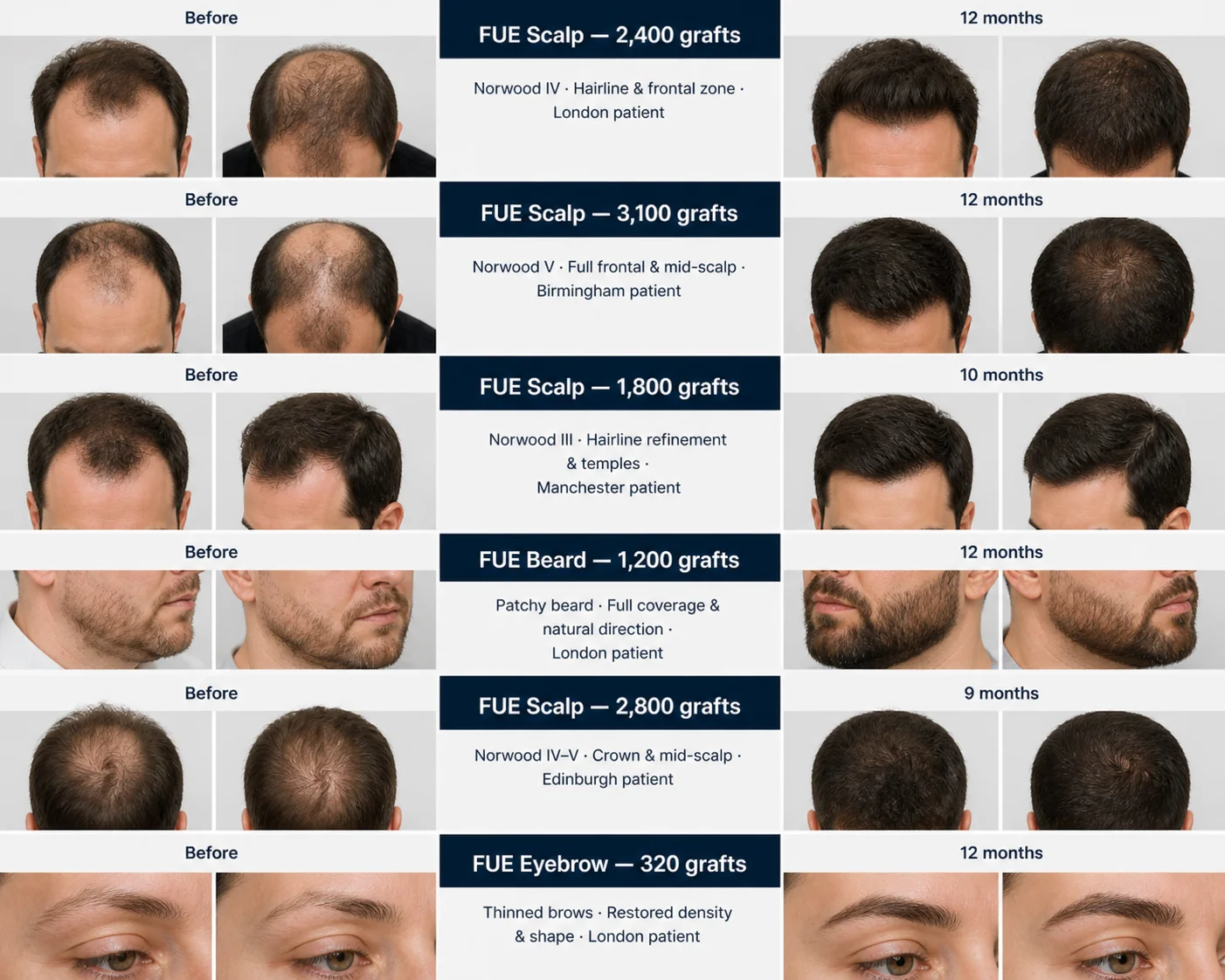 FUE Hair Transplant Before and After