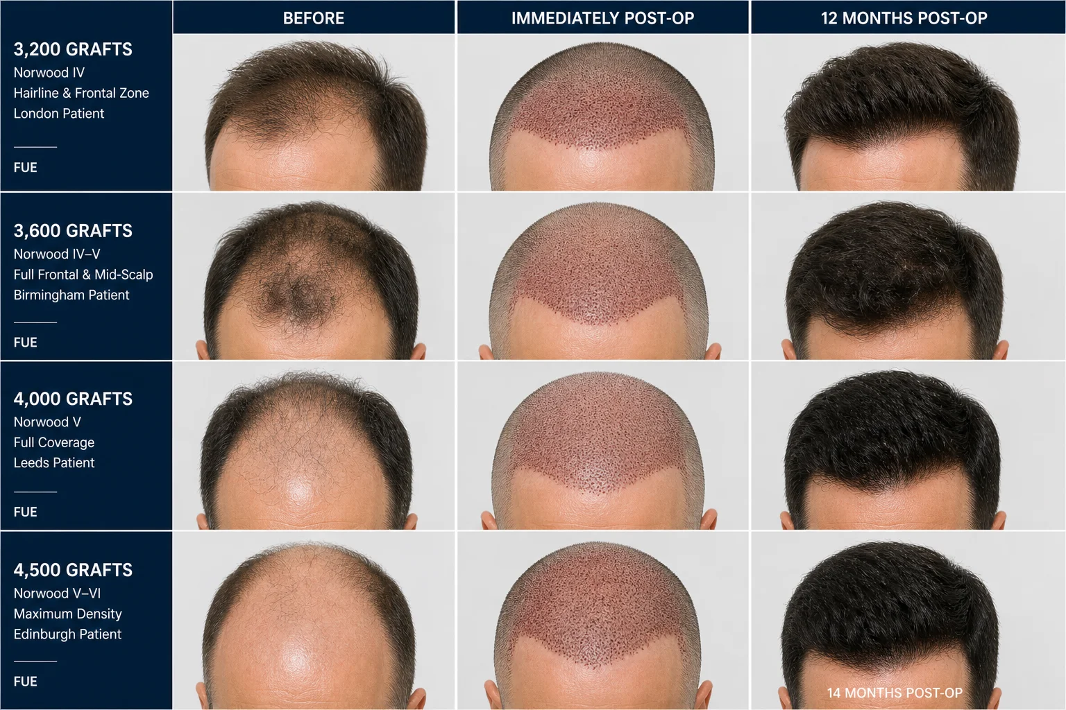 FUE Hair Transplant Before and After