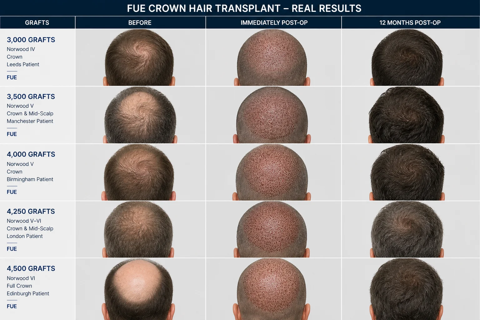 FUE Crown Hair Transplant Before and After