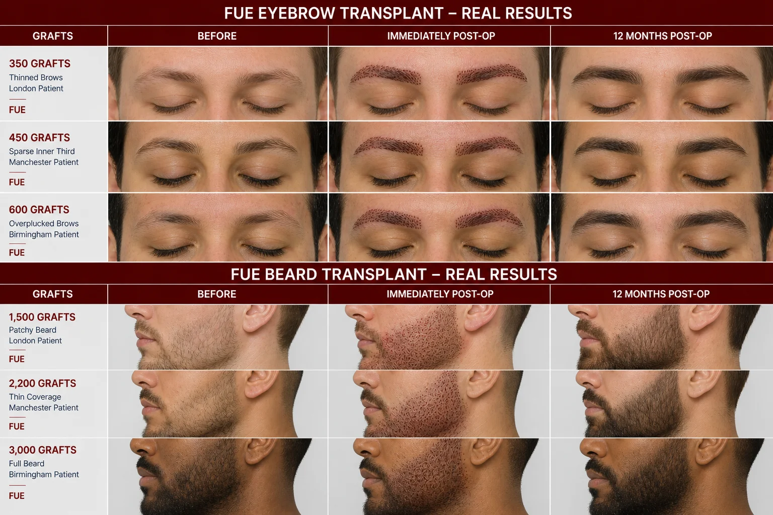 Eyebrow and Beard Transplant Before and After