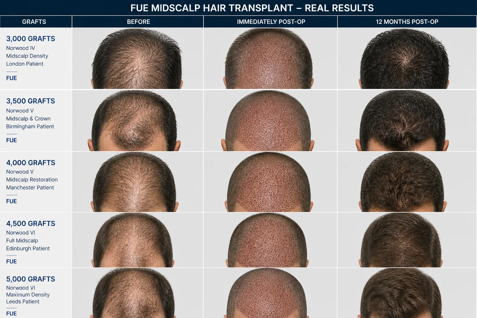FUE Mid-Scalp Hair Transplant Before and After