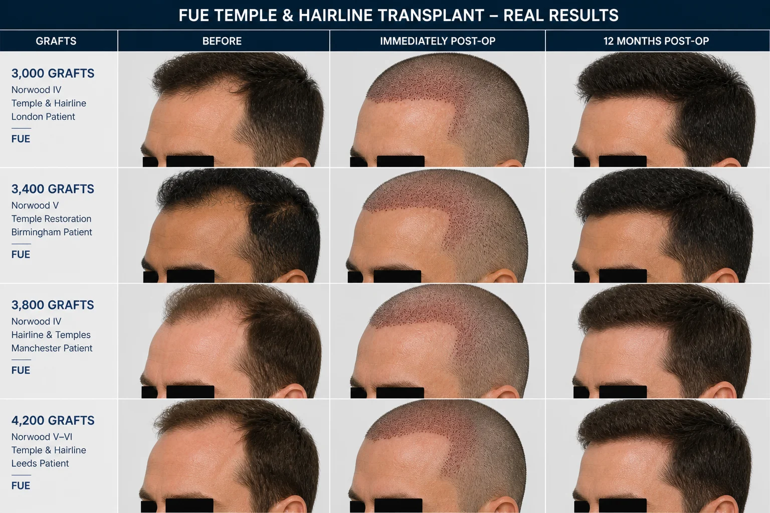 FUE Temple Hair Transplant Before and After